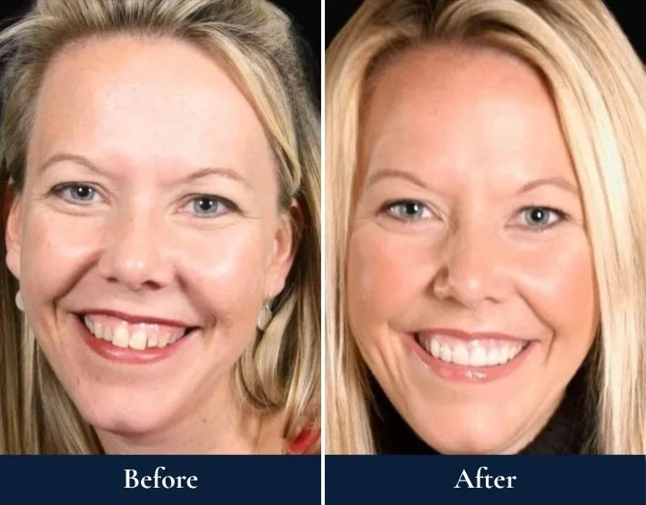 Woman's smile before and after porcelain veneers treatment, showing improved tooth alignment and whiteness