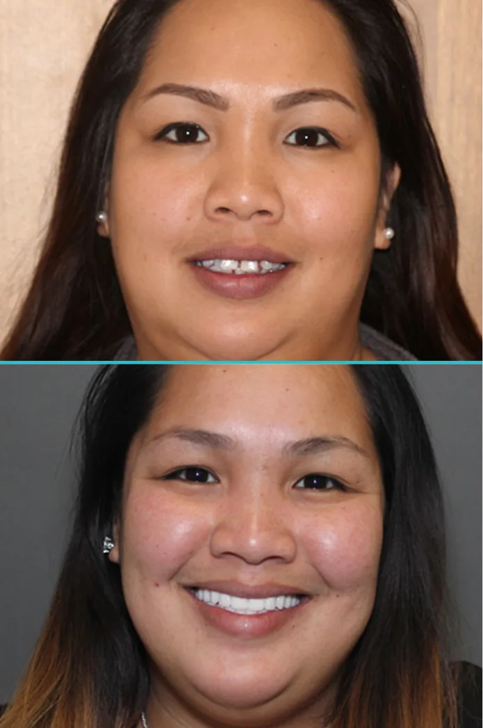 Before and after comparison showing patient with misaligned teeth progressing to straight teeth