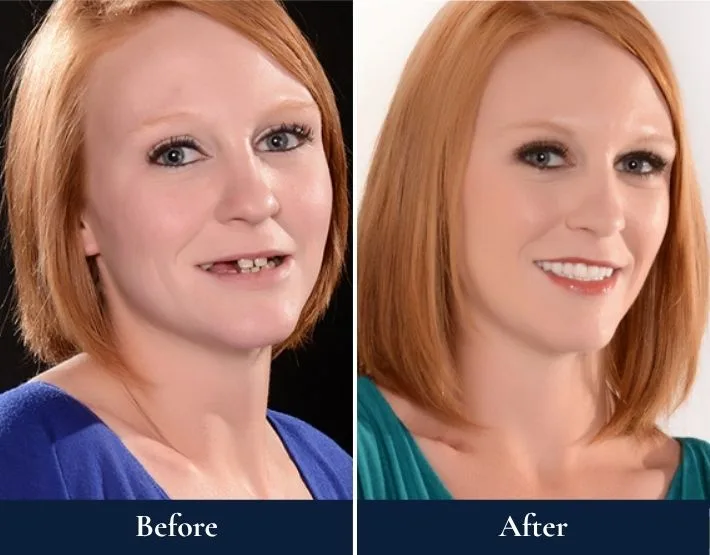 Woman's smile before and after TMJ/TMD treatment, displaying brighter teeth and fuller smile