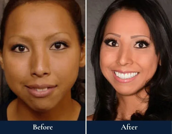 Woman's face before and after TMJ/TMD treatment, showing improved facial symmetry and smile