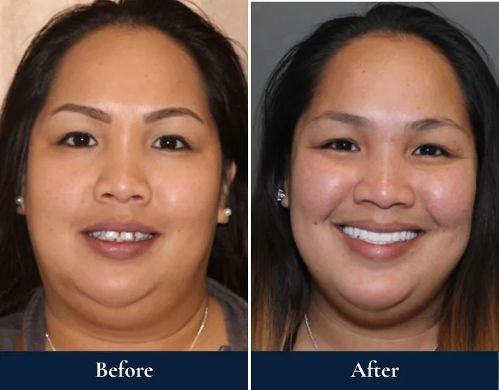 Before and after comparison of woman's smile with W-4 Implant Solution dental work