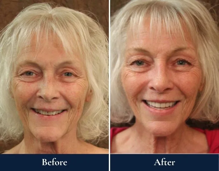 Before and after comparison of woman's smile with W-4 Implant Solution dental work