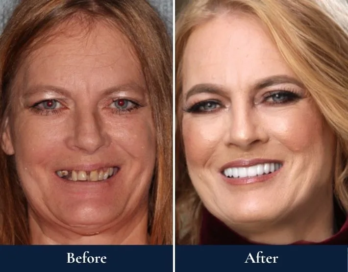 Before and after comparison of woman's smile with W-4 Implant Solution dental work