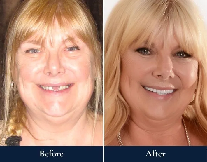 Before and after headshots of Mary Jo with W-4® Implant Solution showing improved smile