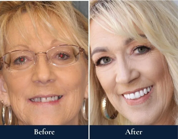 Before and after headshots of Shirley with W-4® Implant Solution showing improved smile