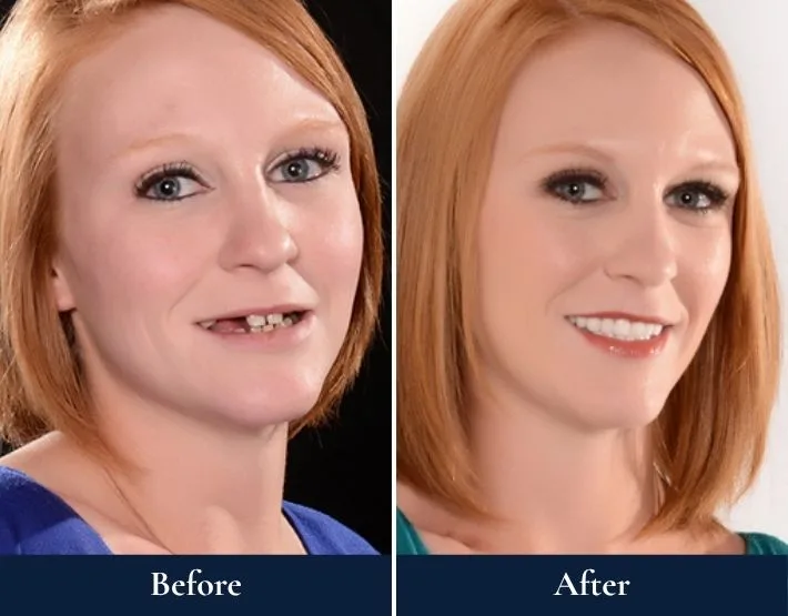 Before and after headshots of Chelsey with W-4® Implant Solution showing improved smile