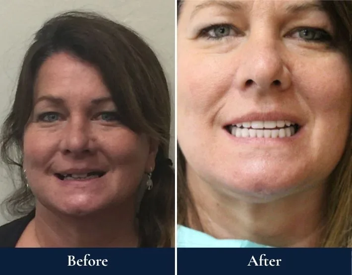 Before and after comparison of woman's smile with W-4 Implant Solution dental work