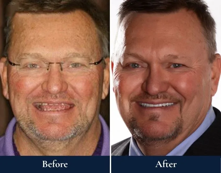 Before and after comparison of man's smile with W-4 Implant Solutions dental work