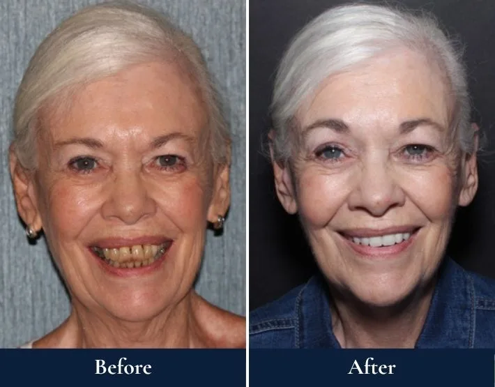Before and after headshots of Sally with W-4® Implant Solution showing improved smile