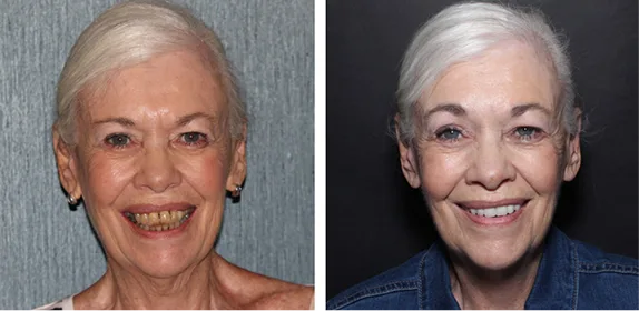 Before and after smile comparison showing woman's teeth transformation