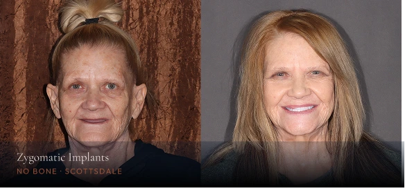 Before-and-after photos of woman's smile, labeled Zygomatic Implants, No Bone, Scottsdale
