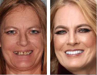 Before and after smile comparison: woman with discolored teeth on left, bright white smile on right