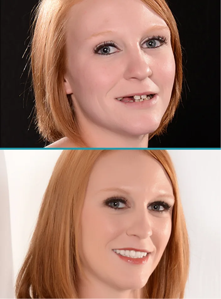 Before and after comparison of woman with improved smile showing dental treatment results