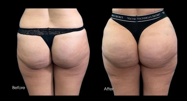 Before and after rear view comparison of Brazilian butt lift results showing increased volume and lift