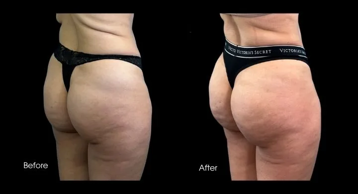 Before and after side view comparison of Brazilian butt lift results showing enhanced shape and projection