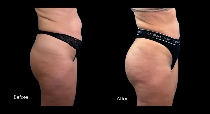 Before and after side view comparison of Brazilian butt lift results highlighting buttock enhancement