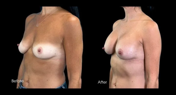Breast augmentation before and after comparison, oblique view