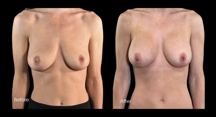 Breast augmentation before and after comparison, front view