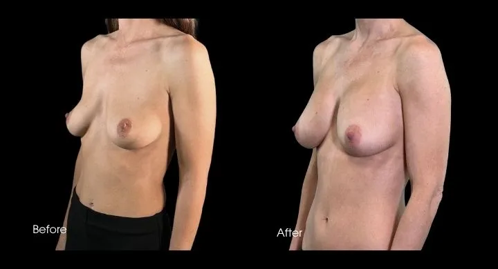 Breast augmentation before and after comparison, oblique side view