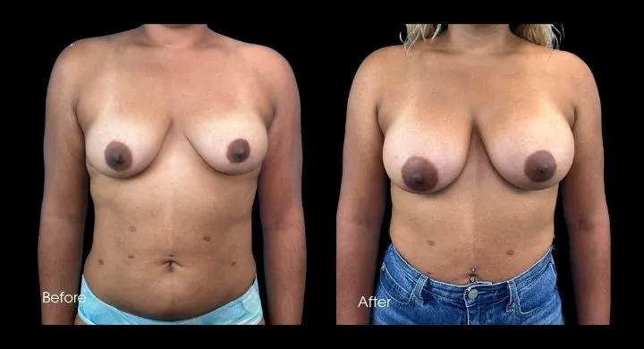 Breast augmentation before and after, frontal view showing increased volume and fullness