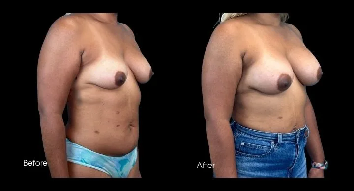 Breast augmentation before and after, side view showing enhanced projection and contour
