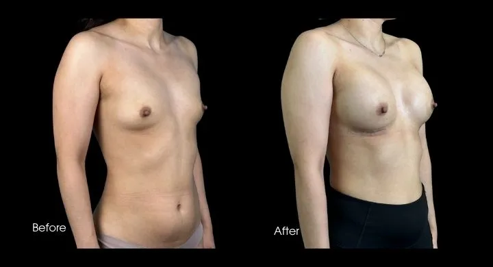 Breast augmentation before and after, oblique view showing improved symmetry and shape