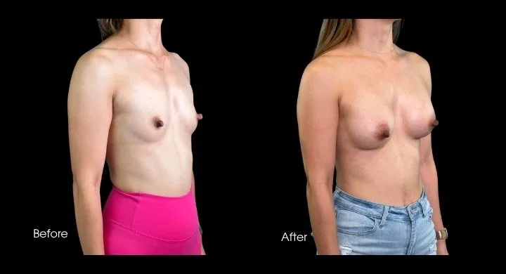 Breast augmentation before and after, side view showing natural contour and increased fullness