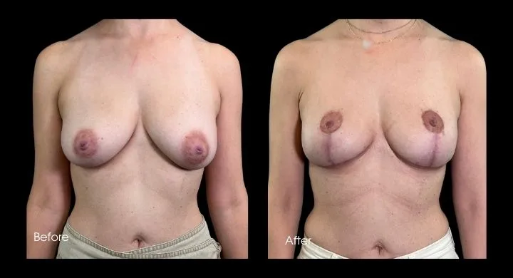 Breast lift before and after comparison, frontal view showing lifted contours and repositioned nipples