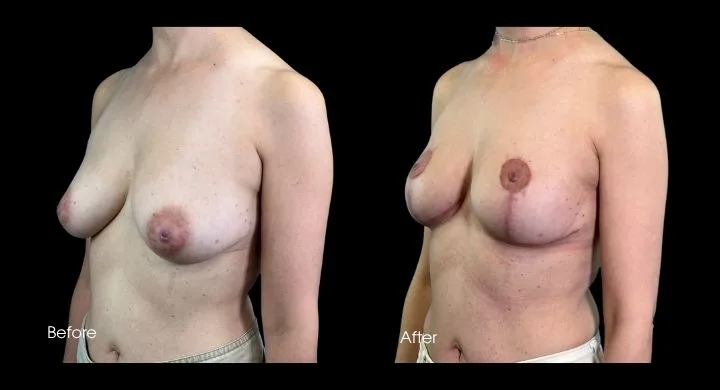 Breast lift before and after comparison, side view showing improved projection and elevation