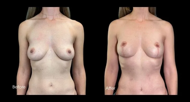 Breast lift before and after comparison, frontal view with long hair showing lifted appearance