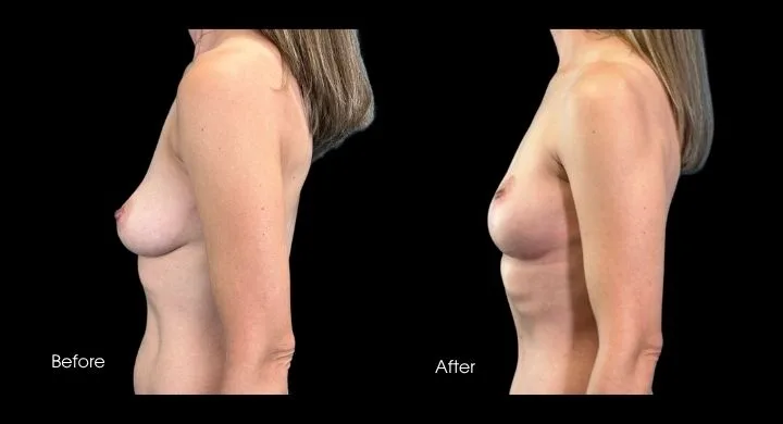 Breast lift before and after comparison, side view showing enhanced contour and position