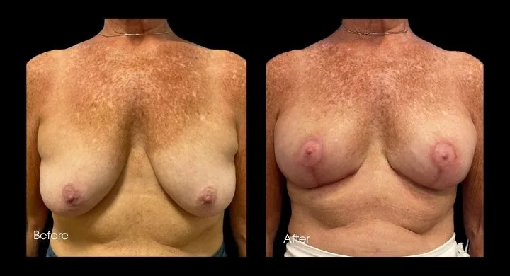 Breast lift with fat transfer before and after comparison