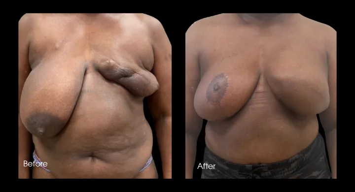 Breast reconstruction before and after comparison, delayed reconstruction procedure