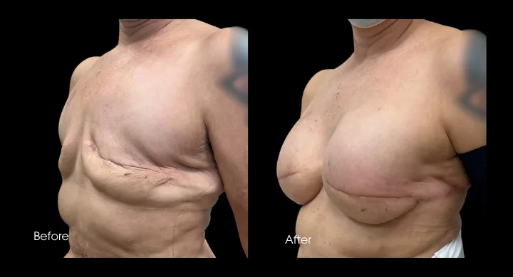 Breast reconstruction before and after comparison, delayed reconstruction procedure