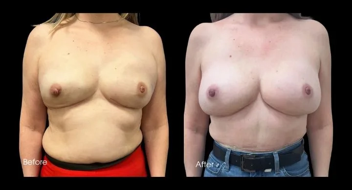 Before and after breast reconstruction with DIEP flap, frontal view