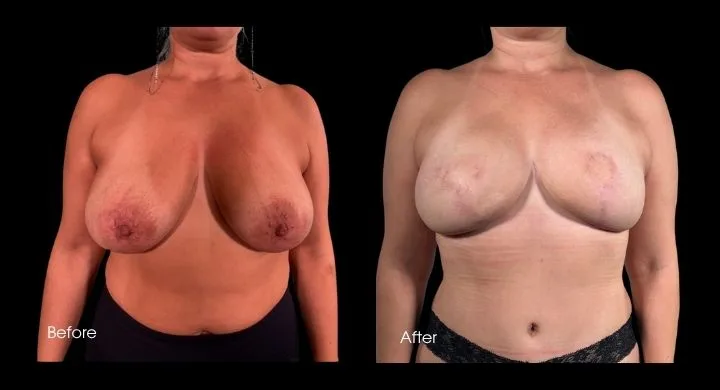 Before and after breast reconstruction with DIEP flap, frontal view showing improved symmetry