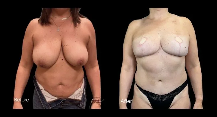 Before and after breast reconstruction with DIEP flap, frontal view with abdominal donor site