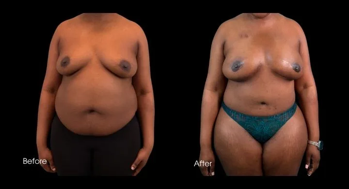 Breast reconstruction with DIEP flap before and after, frontal view showing restored breast shape