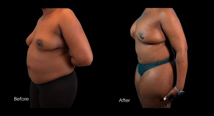 Breast reconstruction with DIEP flap before and after, side view showing reconstructed breast contour