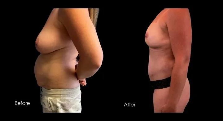 Breast reconstruction before and after using DIEP flap, side profile view