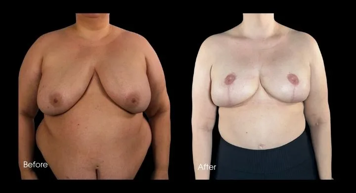 Breast reconstruction before and after using DIEP flap, front view
