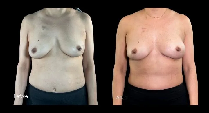 Breast reconstruction before and after using DIEP flap, front view