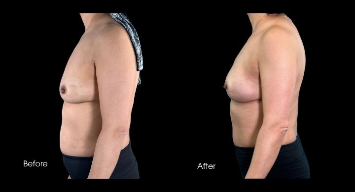 Breast reconstruction before and after using DIEP flap, side profile view