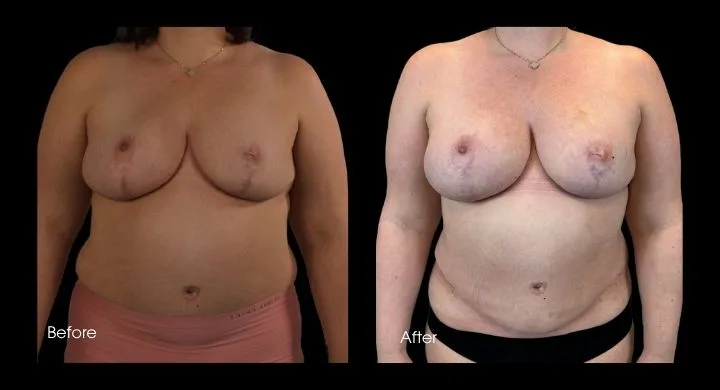 Before and after breast reconstruction with improved symmetry and natural contour