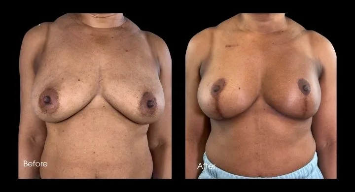 Breast reconstruction before and after using DIEP flap, front view