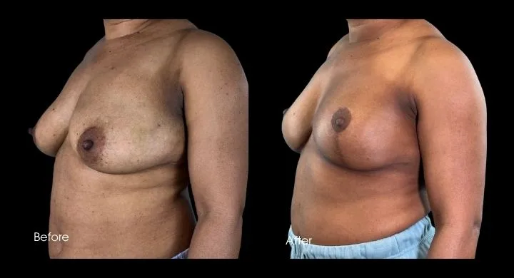 Breast reconstruction before and after using DIEP flap, side profile view