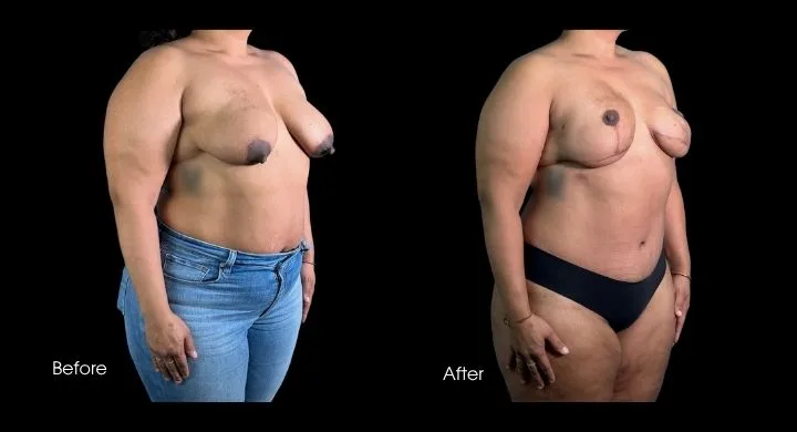 Breast reconstruction before and after using DIEP flap, front view