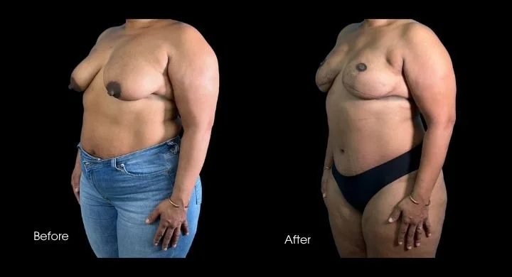 Breast reconstruction before and after using DIEP flap, oblique view