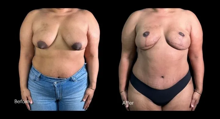 Breast reconstruction before and after using DIEP flap, frontal view