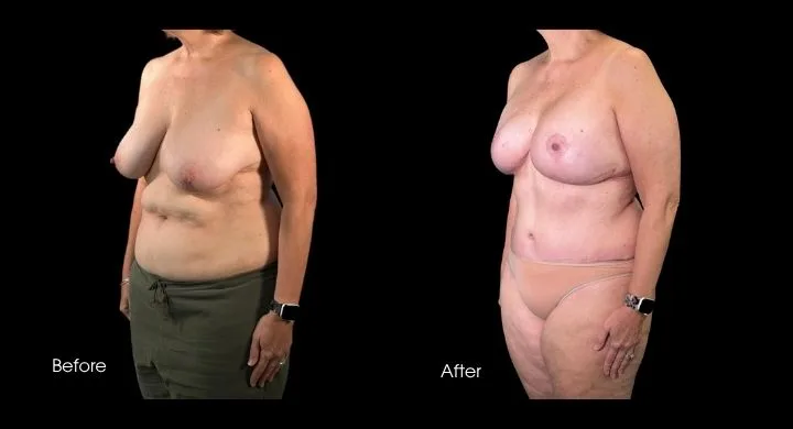 Breast reconstruction before and after using DIEP flap, side view